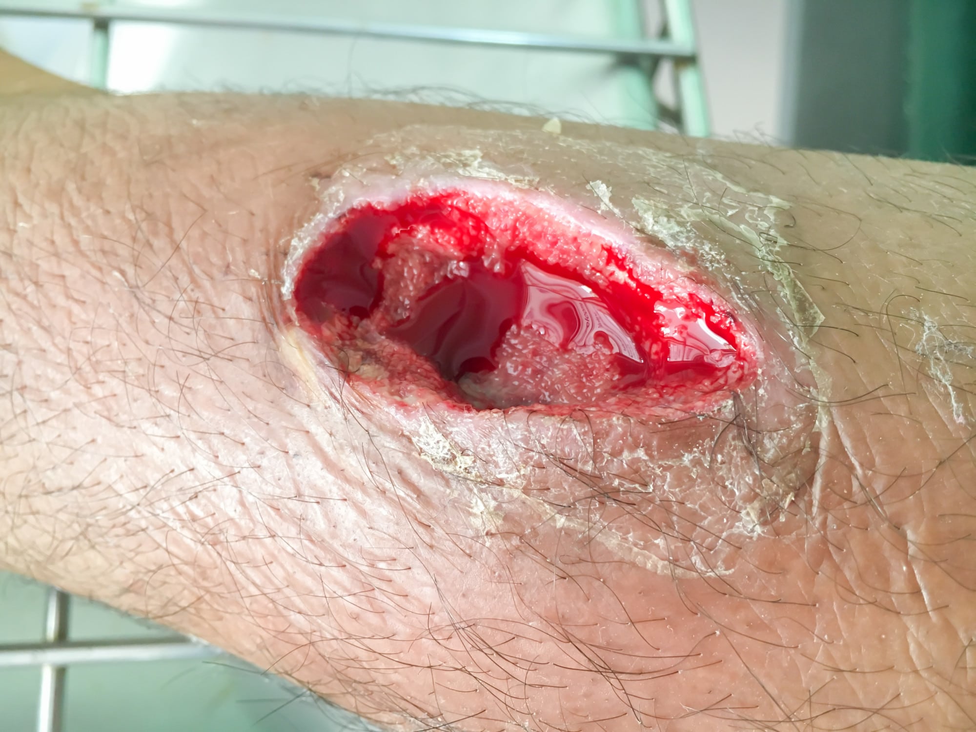 Before You Bandage: How to Properly Clean a Wound