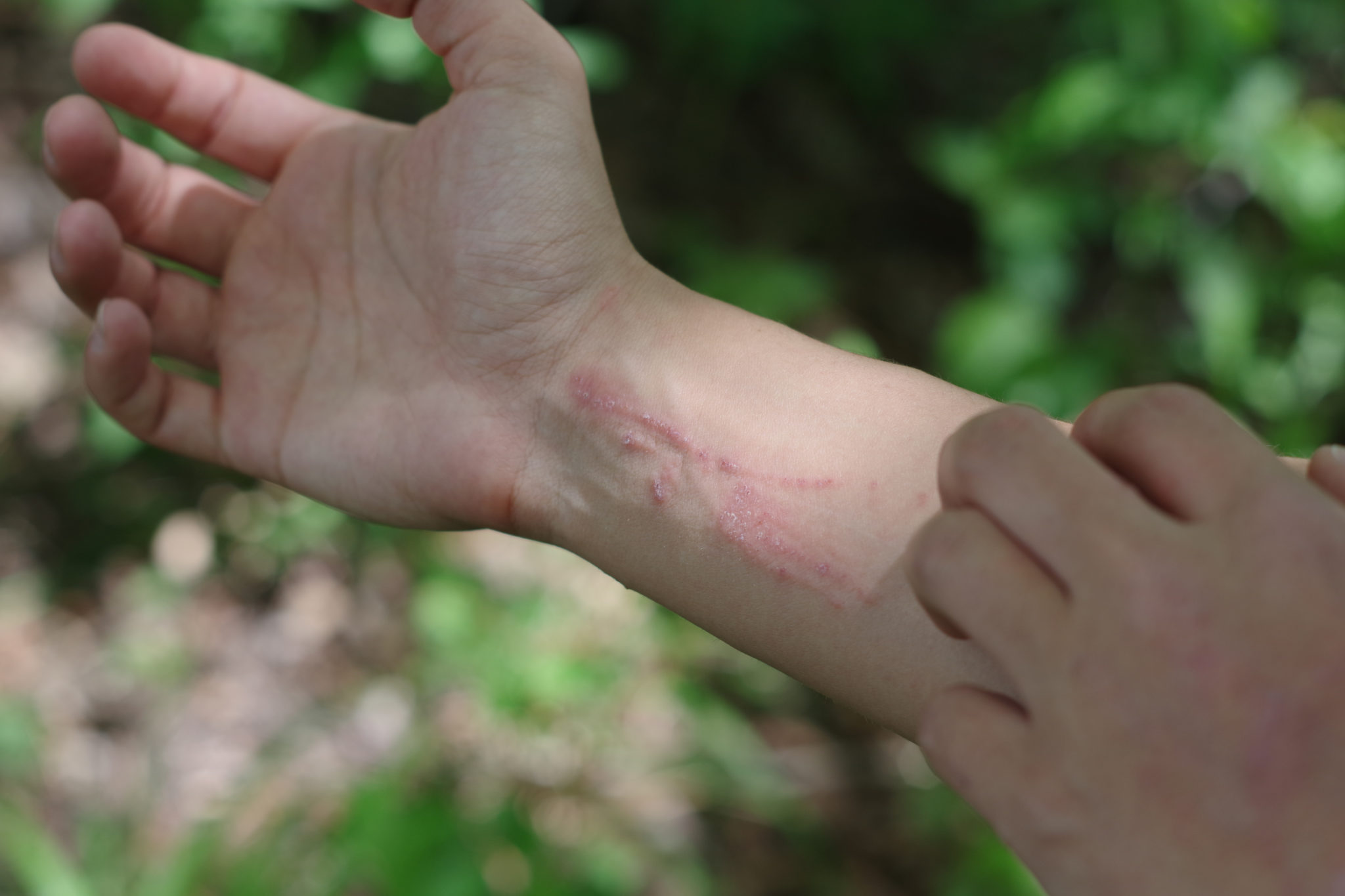 how-long-before-poison-ivy-rash-appears