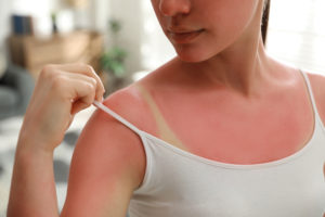 A close-up image of a woman in a white tank top pulling down her strap to look at her sunburned shoulder and chest.