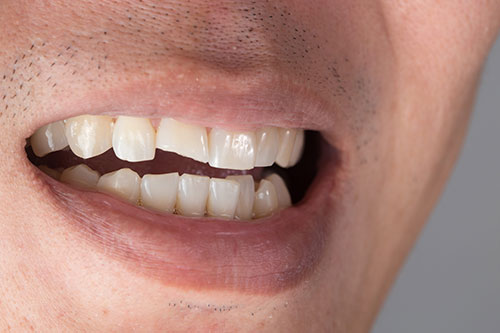 Extreme close-up of a man's mouth with a broken front right tooth