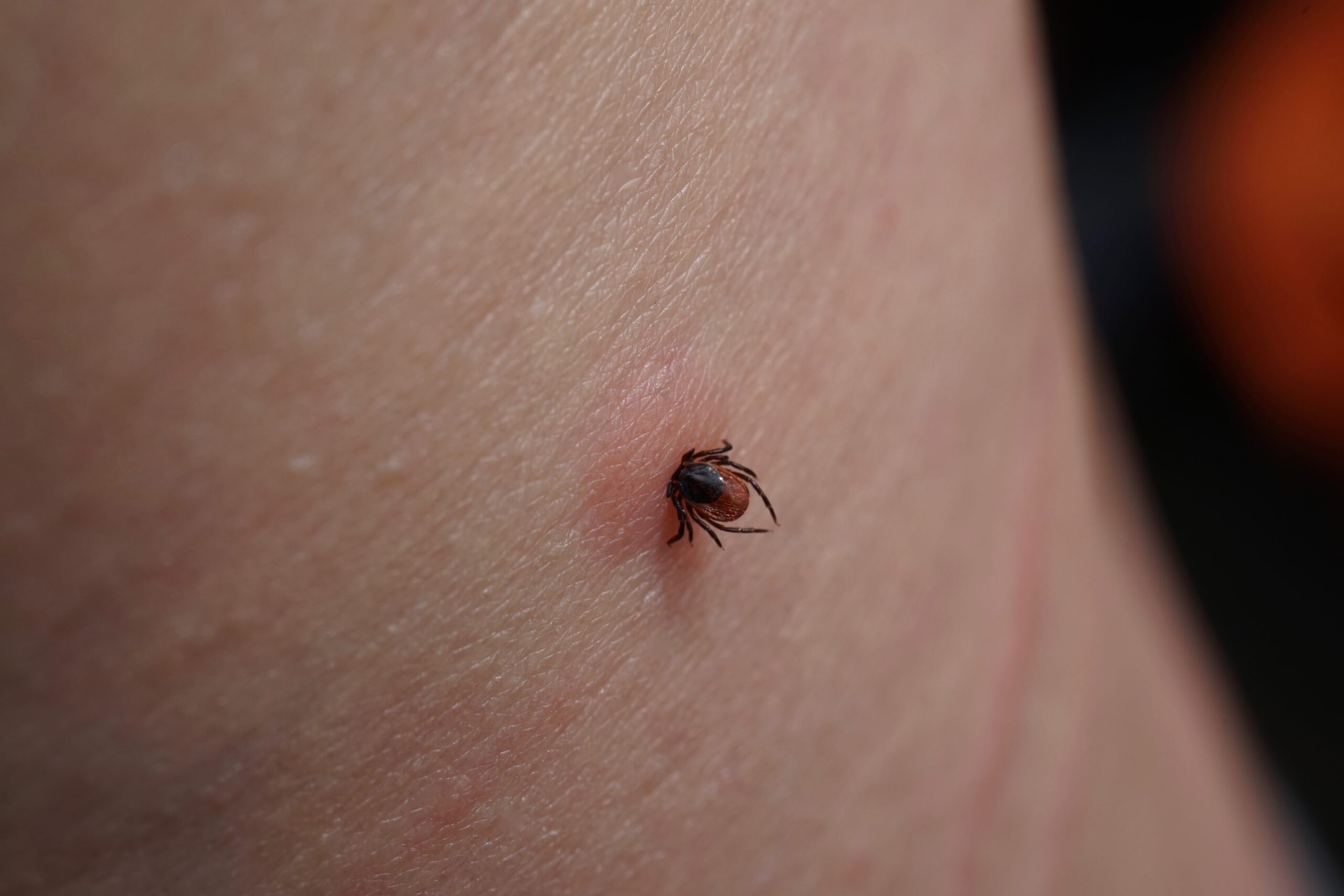 Engorged tick embedded in inflamed human skin, showing the parasite's swollen body attached to reddened epidermis.