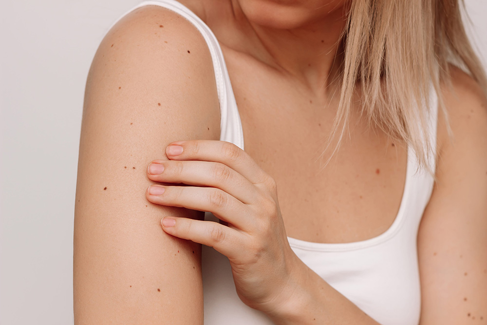 Close-up of a woman's arm showing multiple moles on fair skin against white background, demonstrating sun exposure effects.