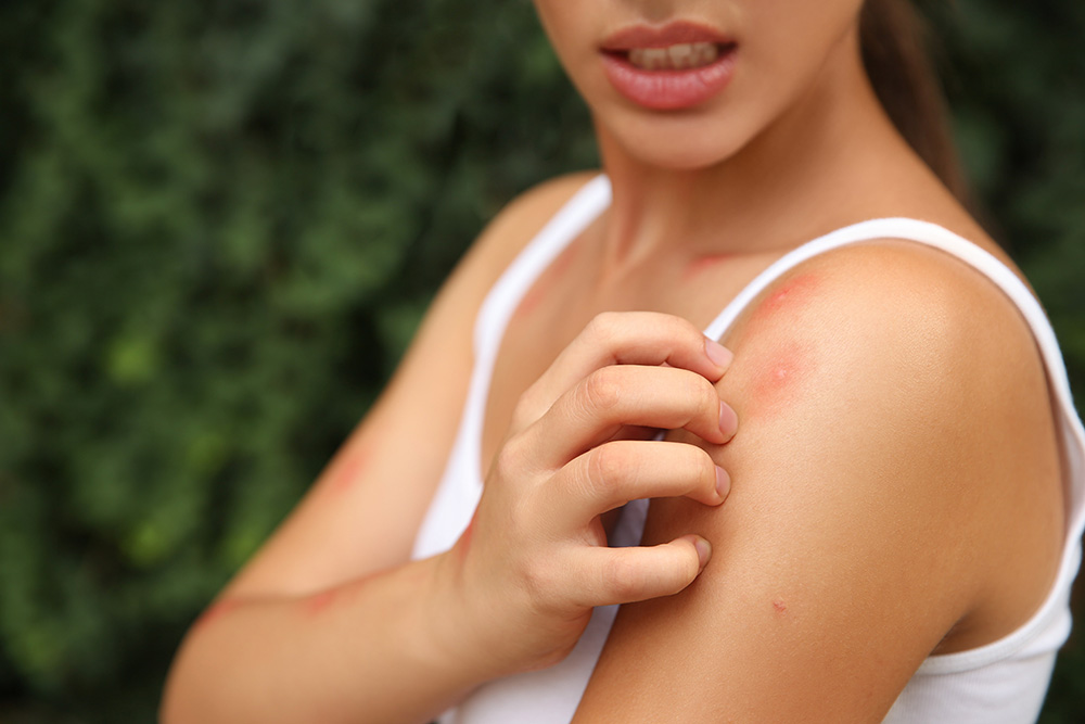 Woman scratching her shoulder outdoors, showing visible insect bite mark on skin
